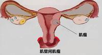 子宫腺肌瘤的易发人群