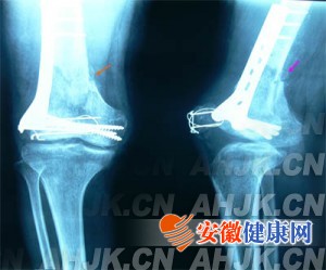 什么原因导致骨折不愈合