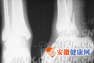 踝关节骨折并发症及处理方法