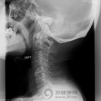 钛圈预防颈椎病的真假