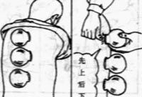 拔罐的常用体位