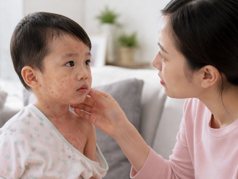 原因：小儿麻疹和什么因素有关？没打疫苗的孩子为何更容易中招