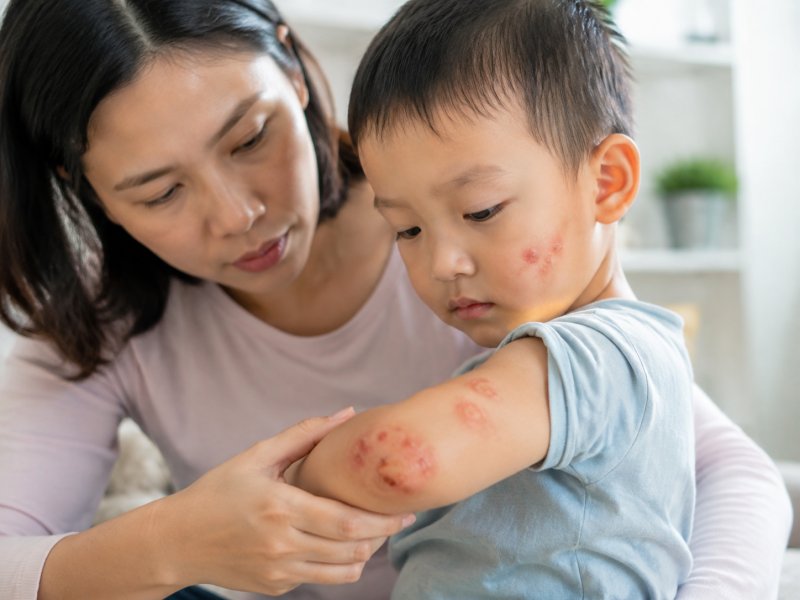 孩子身上长脓疱会不会是脓疱疮？怎么判断典型症状？