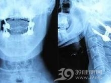 伴齿状突骨折的寰枢椎前脱位