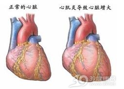 病毒性心肌炎