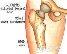 髌骨骨软骨病