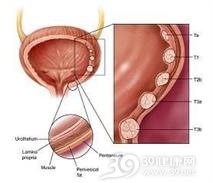膀胱嗜铬细胞瘤