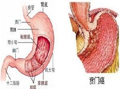 贲门癌