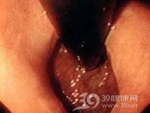 贲门失弛缓症