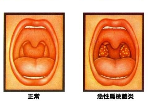 扁桃体炎