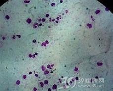 斑疹伤寒立克次体肺炎