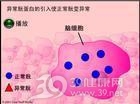 克雅氏病