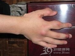 成人类风湿性关节炎性巩膜炎