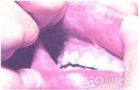 创伤性溃疡