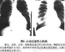持续性交接区折返性心动过速