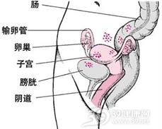 肠子宫内膜异位