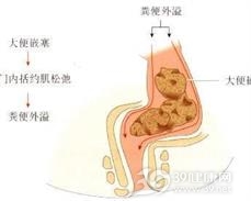 大便失禁