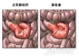 大肠梗阻