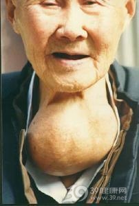 单纯性甲状腺肿