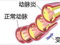大动脉炎