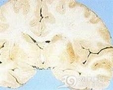 多发脑梗死性痴呆