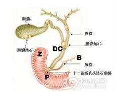 胆管癌