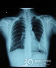 胆固醇脓胸