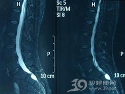 骶管囊肿