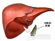 胆囊切除术后综合征