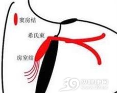 窦室传导