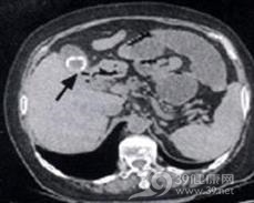 胆石性肠梗阻