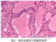 毒性弥漫性甲状腺肿