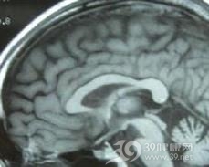 多系统萎缩