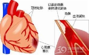 多源性房性心动过速