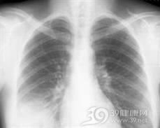 多重肺部感染