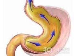 胆汁返流性胃炎