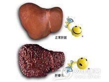 胆汁性肝硬化