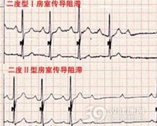 二度房室传导阻滞