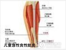 儿童急性良性肌炎
