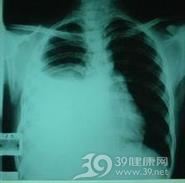 恶性胸腔积液