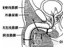 腹壁挫伤