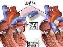 肺动脉发育不全