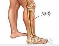 腓骨肌萎缩症