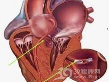 肥厚型梗阻性心肌病