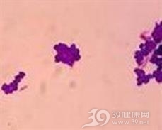 非结核分枝杆菌病