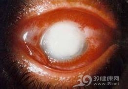 风轮湿热