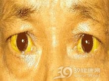 分流性高胆红素血症综合征