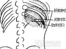 腹膜后感染与脓肿