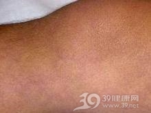 肺泡-毛细血管阻滞综合征