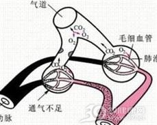 肺泡通气低下综合征